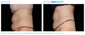 Before and After Emsculpt