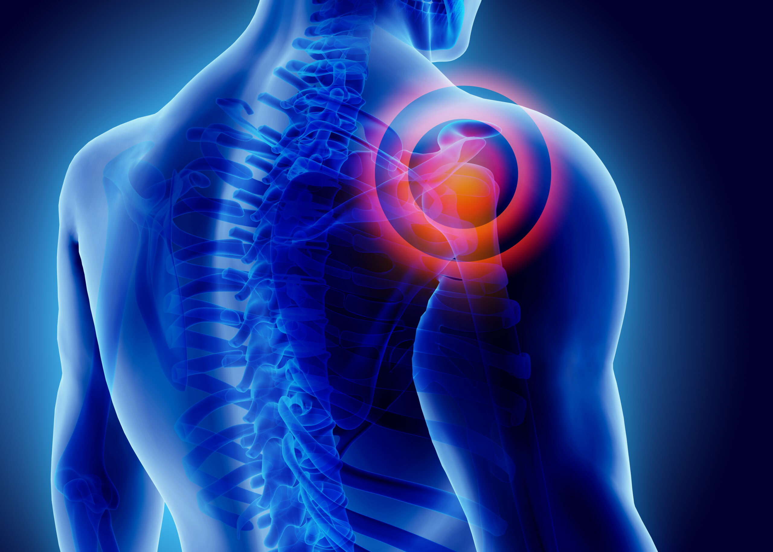 Stemwave for shoulder pain at mPWR